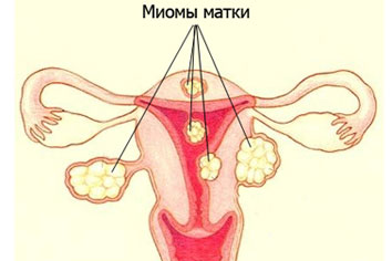 Миома матки - лечение