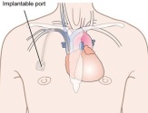 Применение системы PORT-A-CATH