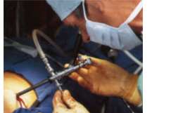 The first kidney laparoscopic resection in Ukraine was executed at LISSOD hospital