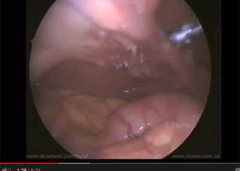 Hybrid NOTES Transvaginal Cholecystectomy