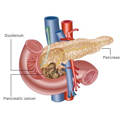 pancreaticcancer