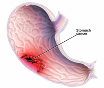 stomachcancer